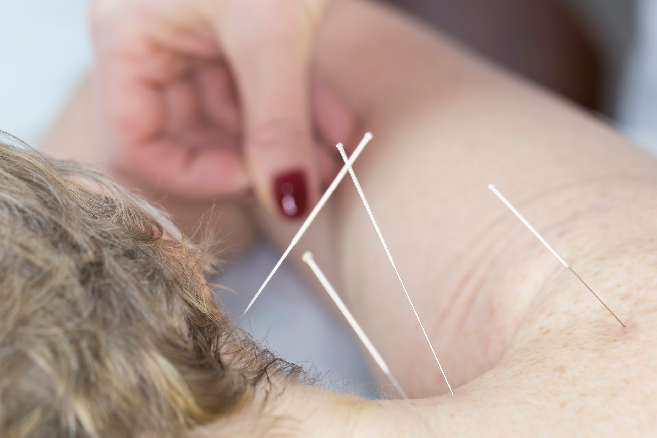Natural Life Acupuncture and Wellness 1 (1) A close-up image of an acupuncture session, with a practitioner delicately inserting thin needles into a patient's shoulder area. The scene highlights the precision and care involved in this therapeutic practice, creating a sense of relaxation and healing.