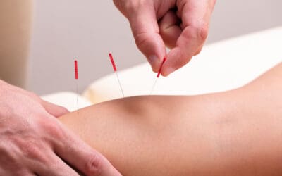 Acupuncture for Sports Injuries and Faster Recovery